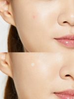COSRX Acne Pimple Master Patch (100% Korean) - Image 2
